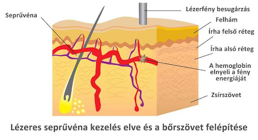 Visszér kezelés lézerrel 4